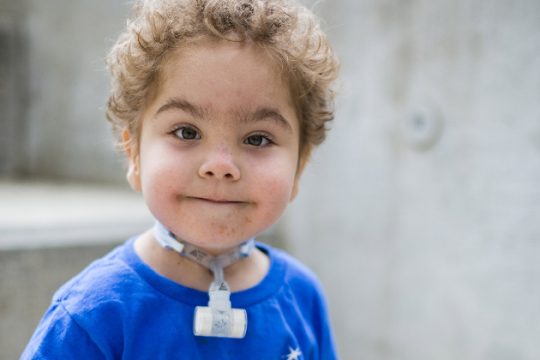 Τρισδιάστατη εκτύπωση εμφυτεύματος σώζει ζωές βρεφών