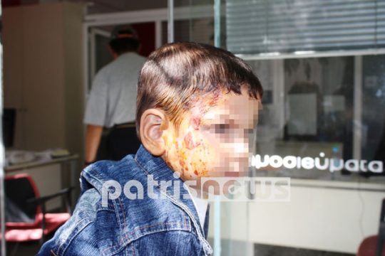 Πέταξε τον καφέ που έβραζε σε 2χρονο παιδί!