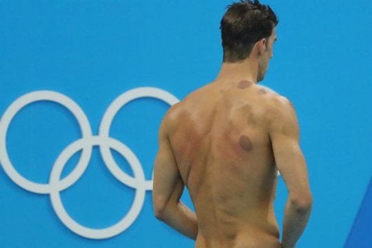 Βεντούζα, βεντούζα!