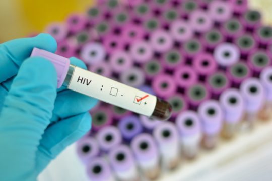Διαγωνισμός προμήθειας αντιδραστηρίων με το βλέμμα στους ασθενείς με AIDS