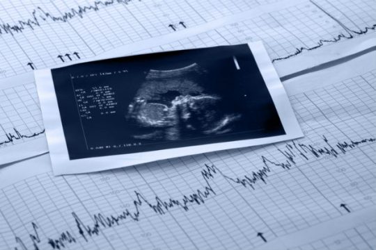 Απόλυση εκπαιδευτικού σε άδεια λοχείας από ιδιωτικό σχολείο