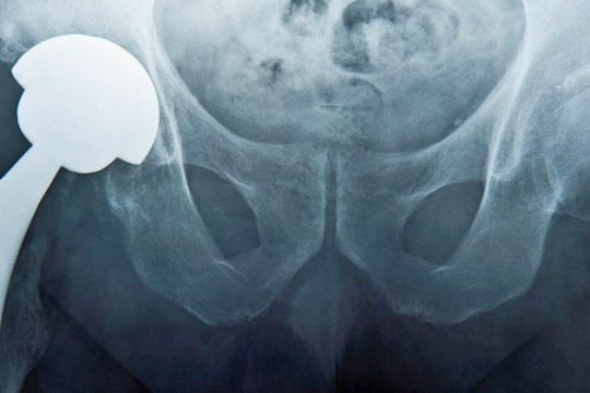Εκατομμύρια χαμένα για μίζες σε χειρουργούς