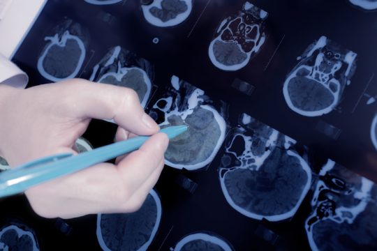 Καταπολέμησαν τη νόσο Πάρκινσον σε πειραματόζωα