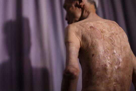 Πέθανε ο εμβληματικός επιζών της ατομικής βόμβας στο Ναγκασάκι