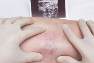 Η μάστιγα των θρομβώσεων και η σημασία της πρόληψης