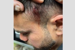 Καταγγελία για φασιστικό χτύπημα στον Αγιο Παντελεήμονα
