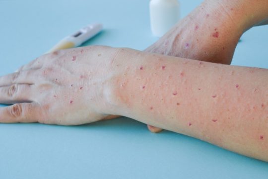 Αύξηση θανάτων από ευλογιά των πιθήκων στην Ευρώπη προβλέπει ο ΠΟΥ