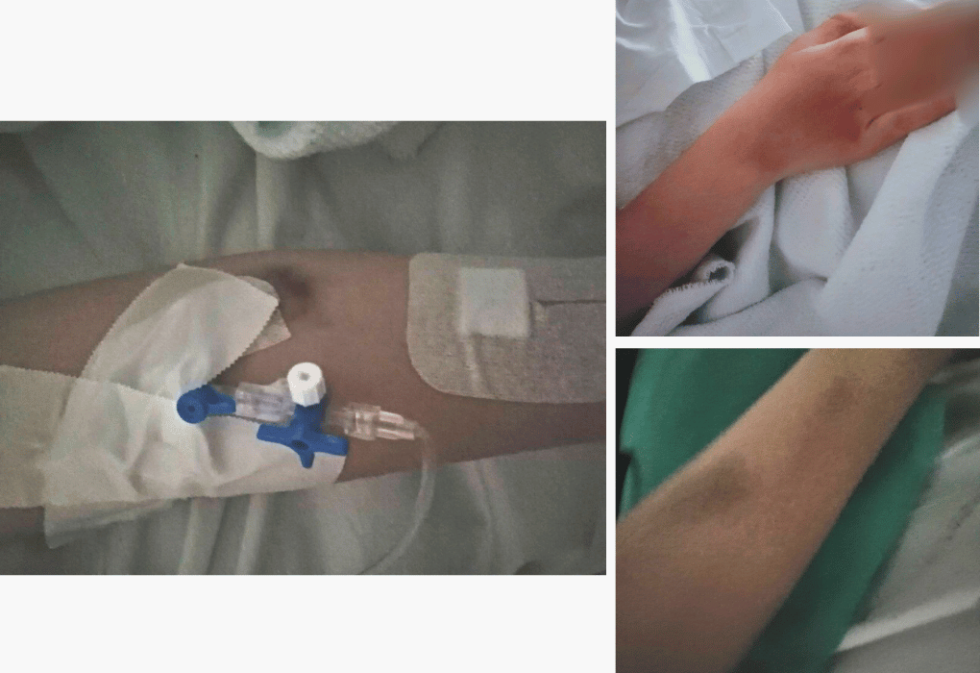 Σύμφωνα με δημοσιεύματα, η 16χρονη που νοσηλεύεται στο Νοσοκομείο «Γεννηματάς» υπέστη κρανιοεγκεφαλική κάκωση