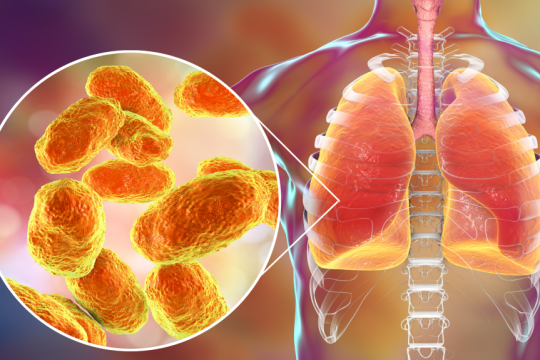 pneumonia
