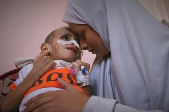 Γάζα- μητέρα με το υποσιτισμένο μωρό της στην αγκαλιά της σε νοσοκομείο