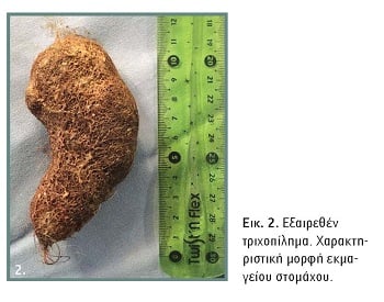 Τι είναι το σύνδρομο Ραπουνζέλ που είχε η 14χρονη με την τρίχινη μπάλα στο στομάχι